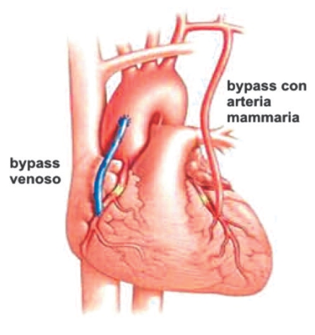 Bypassaorto-coronarico